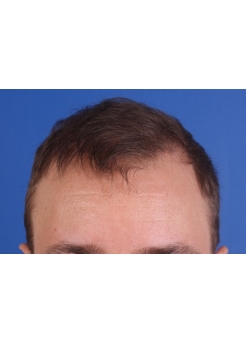 After Hair Transplant&nbsp;Front